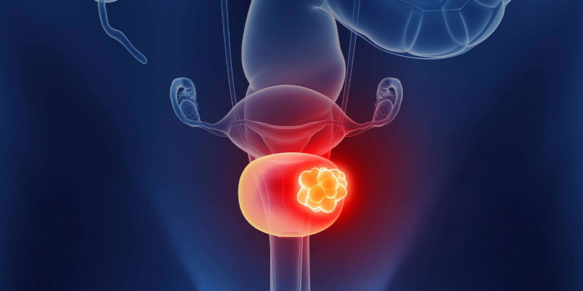 ../Image/bladder-cancer1.jpeg