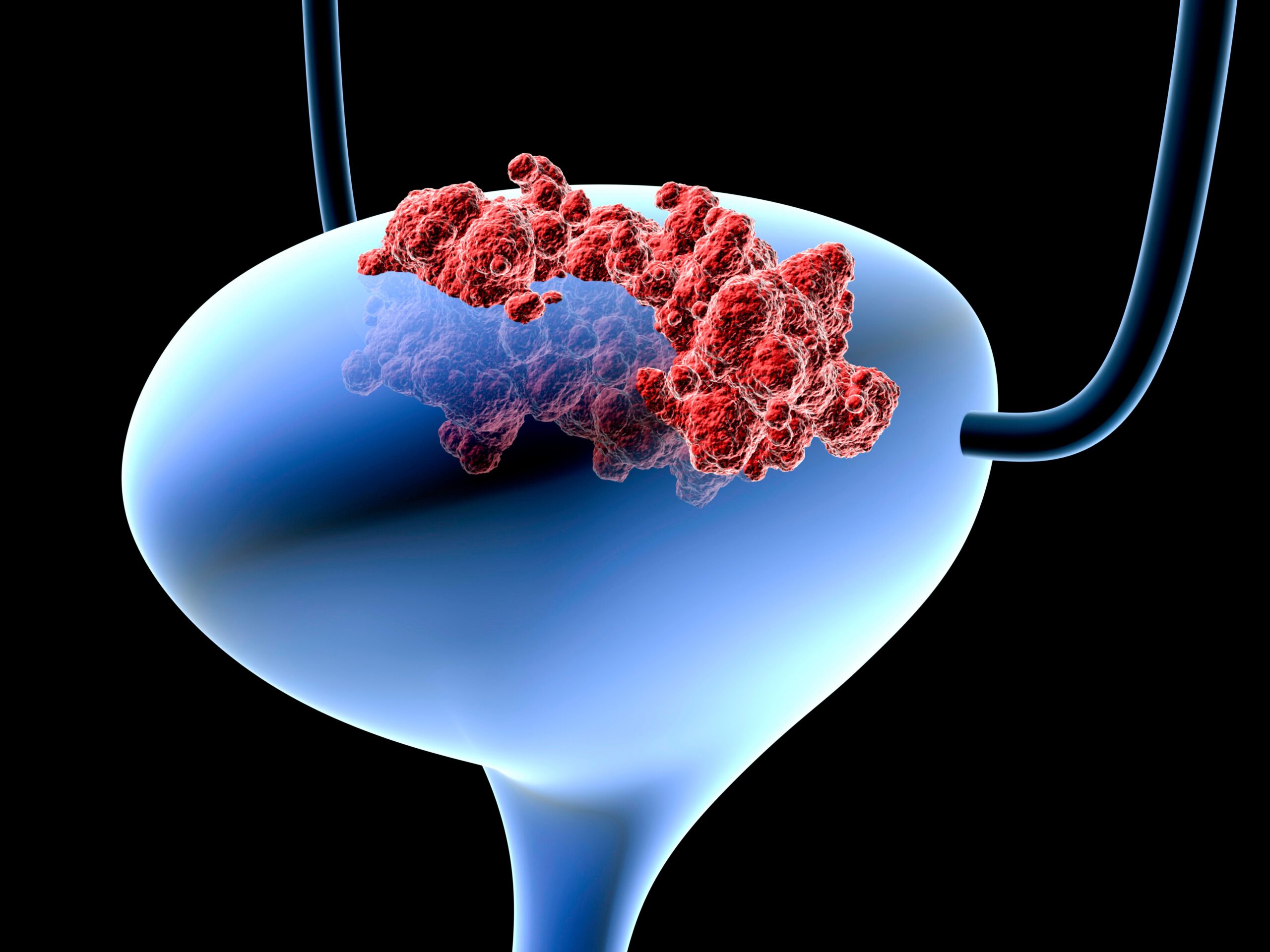 ../Image/bladder-cancer4.jpeg