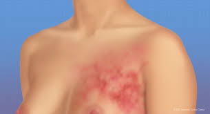 ../Image/breast-cancer1.jpeg
