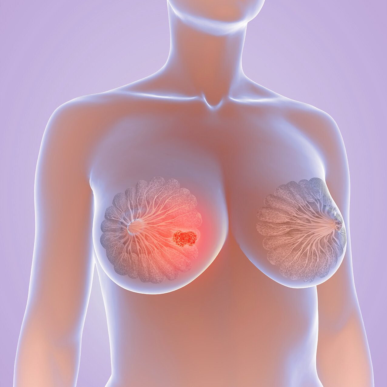 ../Image/breast-cancer3.jpeg