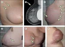 ../Image/breast-cancer4.jpeg