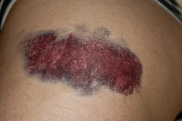 ../Image/bruises1.jpeg