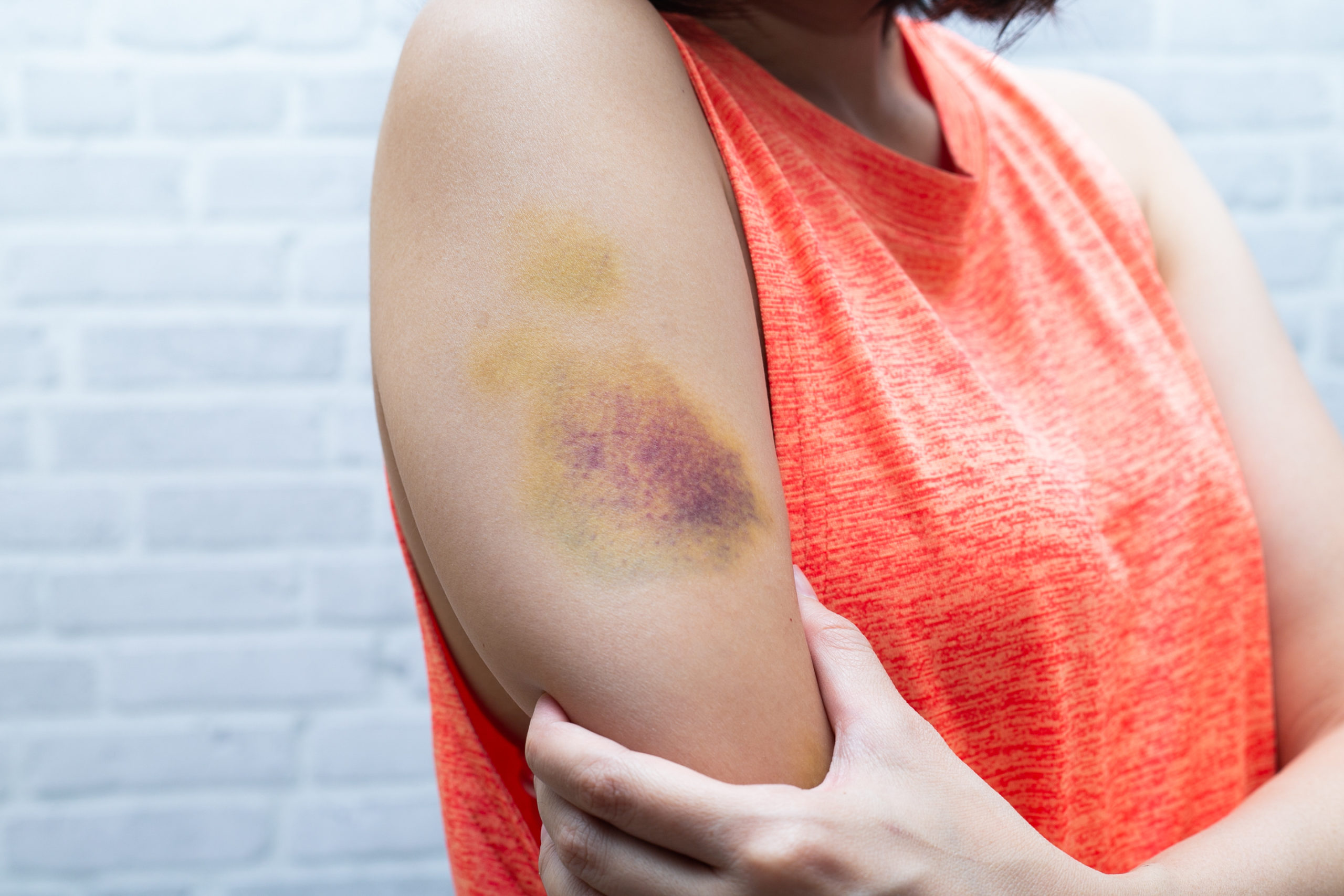 ../Image/bruises2.jpeg