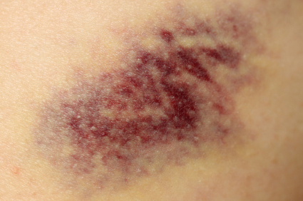 ../Image/bruises1