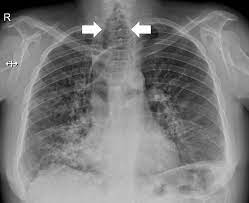 ../Image/croup2.jpeg
