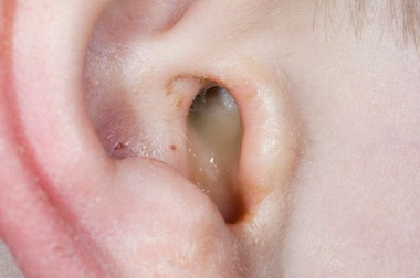 ../Image/ear1