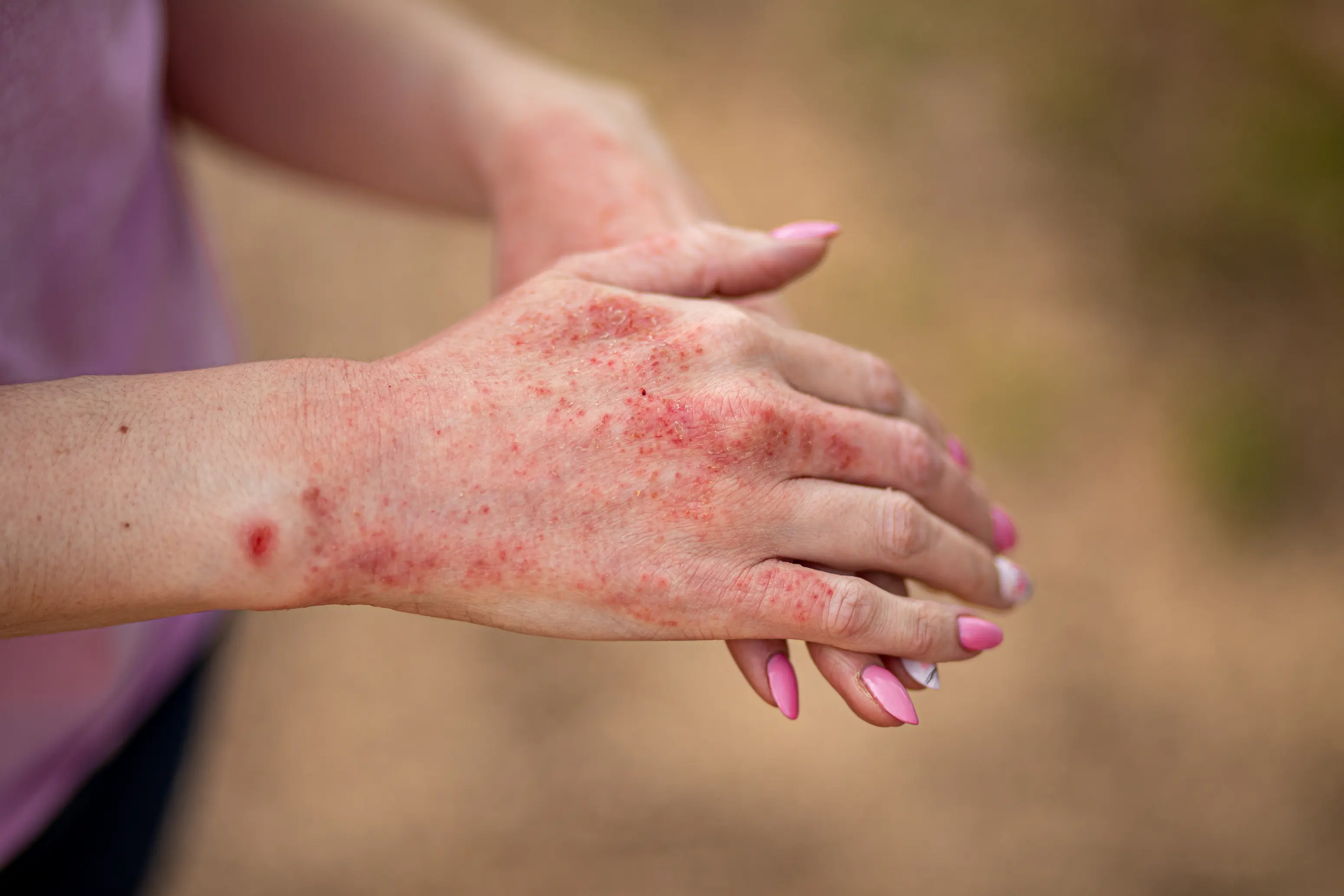 ../Image/eczema1.jpeg