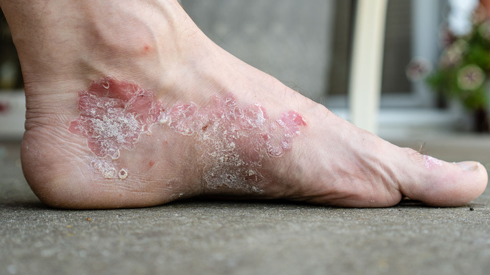../Image/eczema2.jpeg