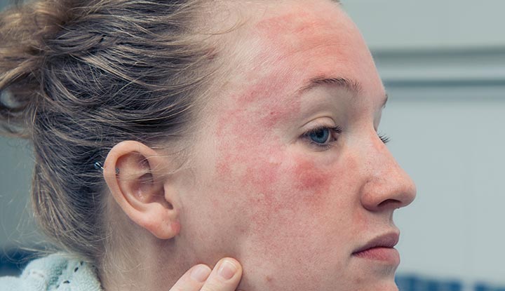 ../Image/eczema1