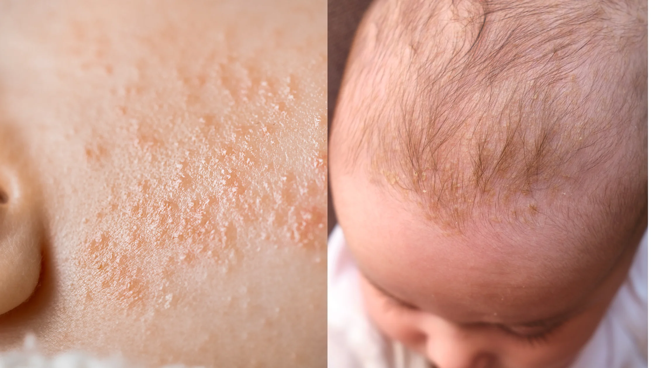../Image/eczema4.jpeg