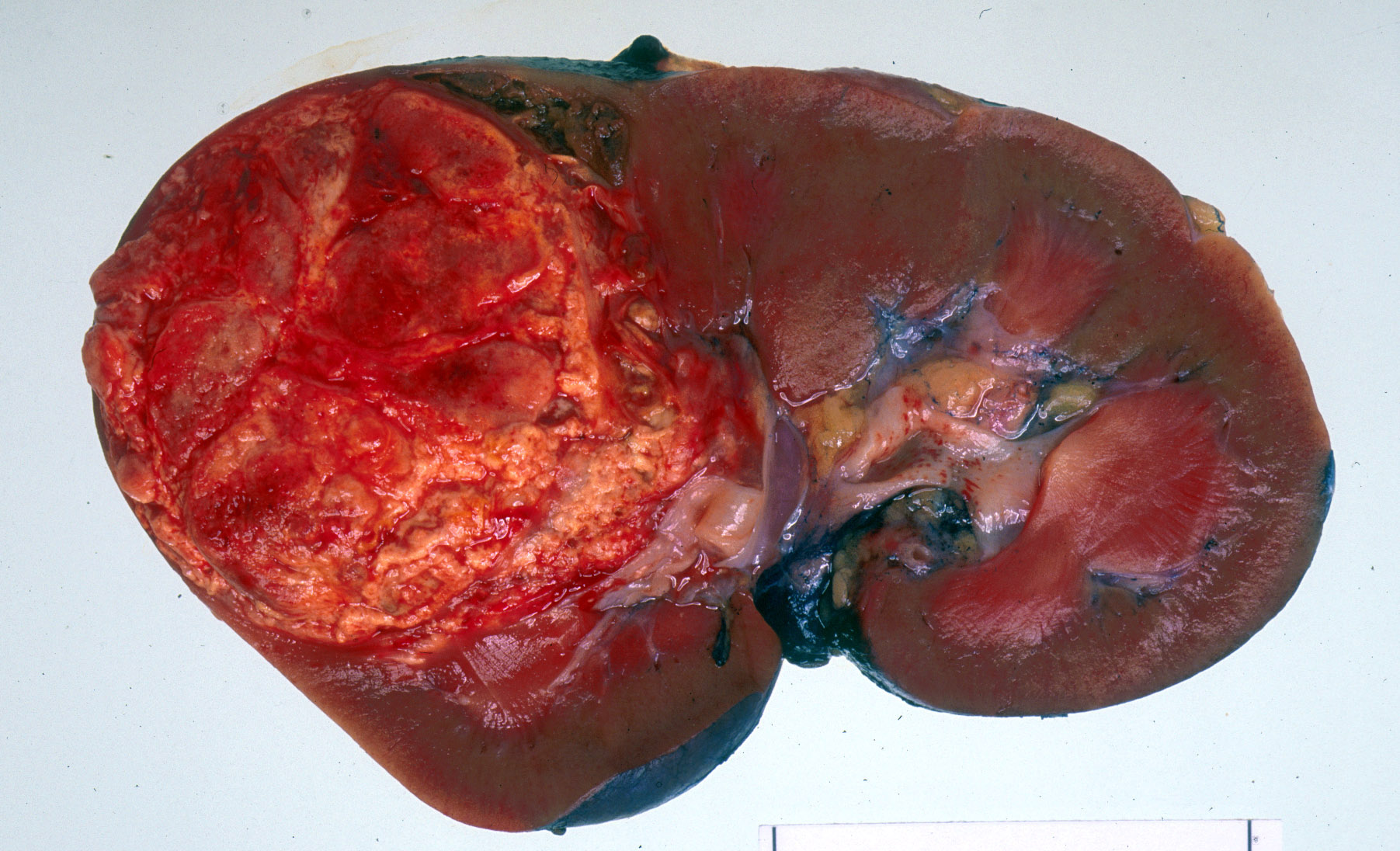 ../Image/kidney-cancer2.jpeg