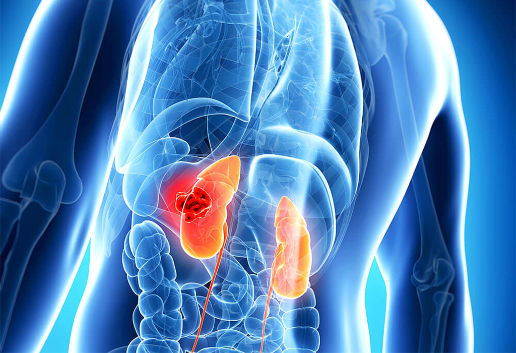 ../Image/kidney-cancer1