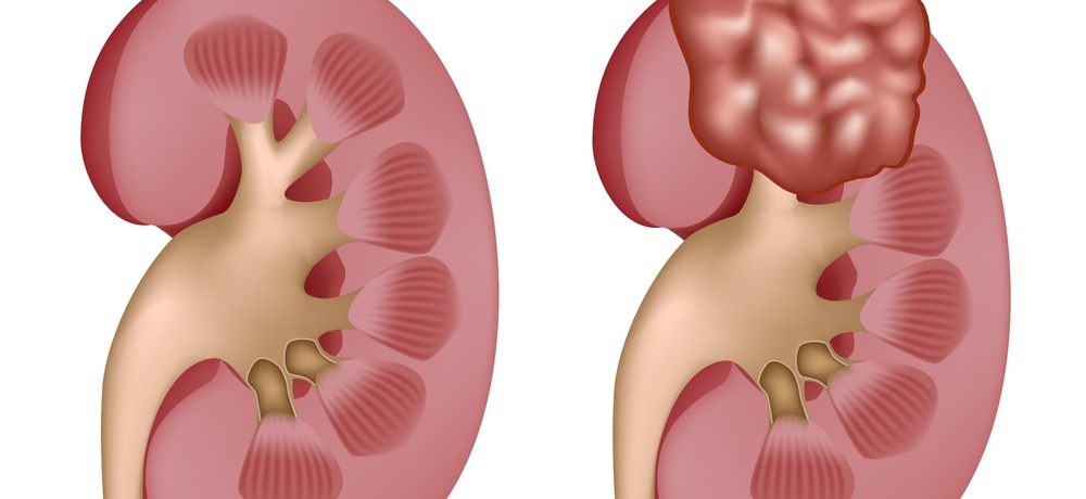 ../Image/kidney-cancer4.jpeg