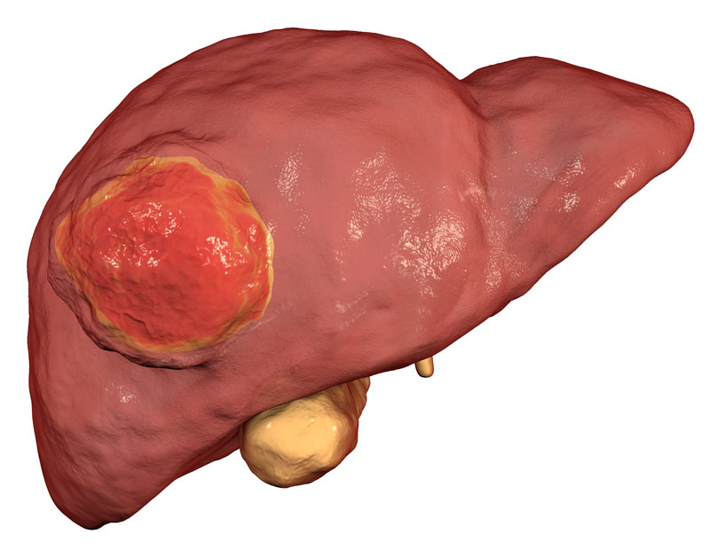 ../Image/liver-cancer1.jpeg