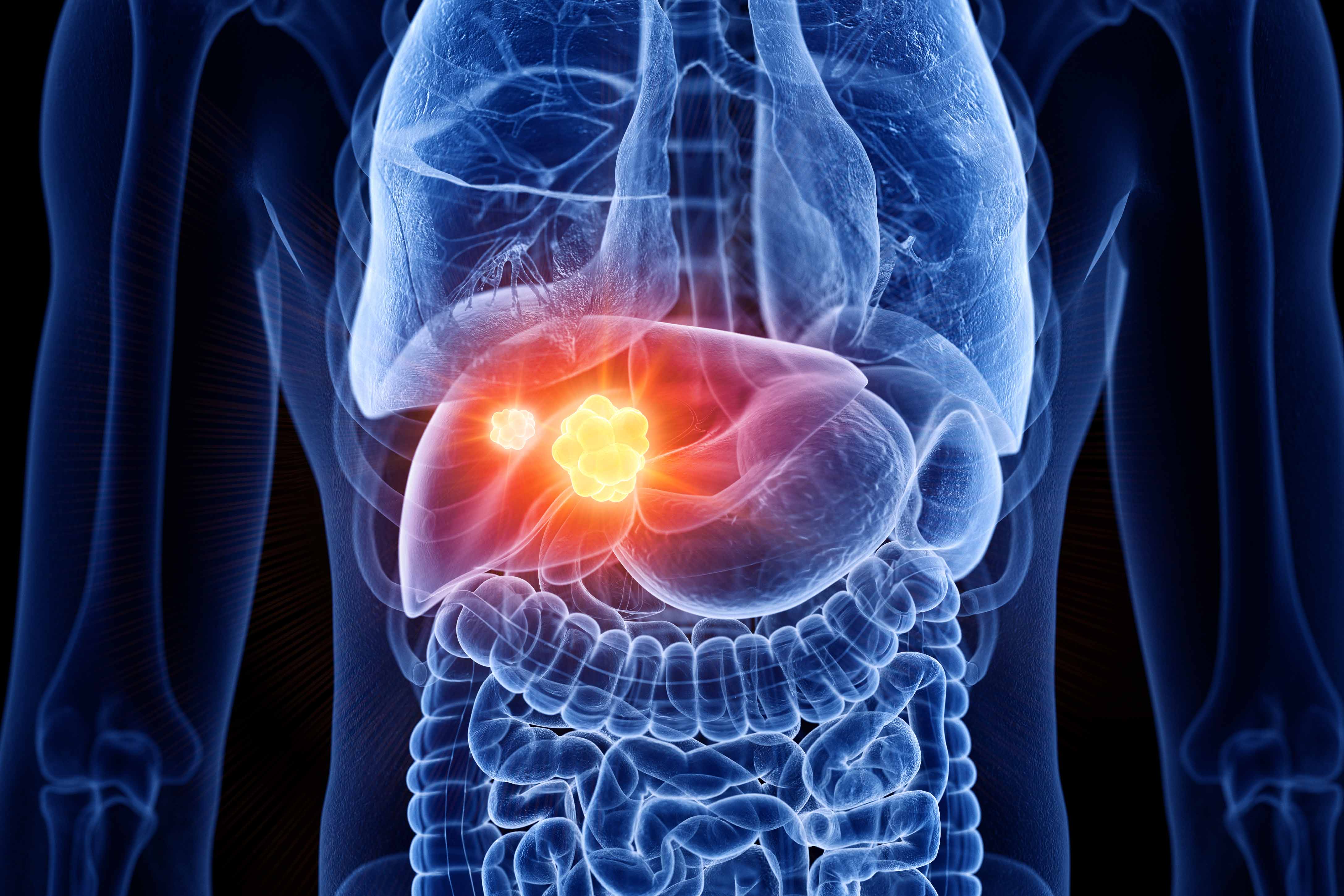 ../Image/Liver-cancer1