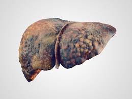 ../Image/liver-cancer3.jpeg