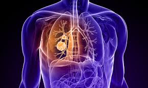 ../Image/lung-cancer3.jpeg