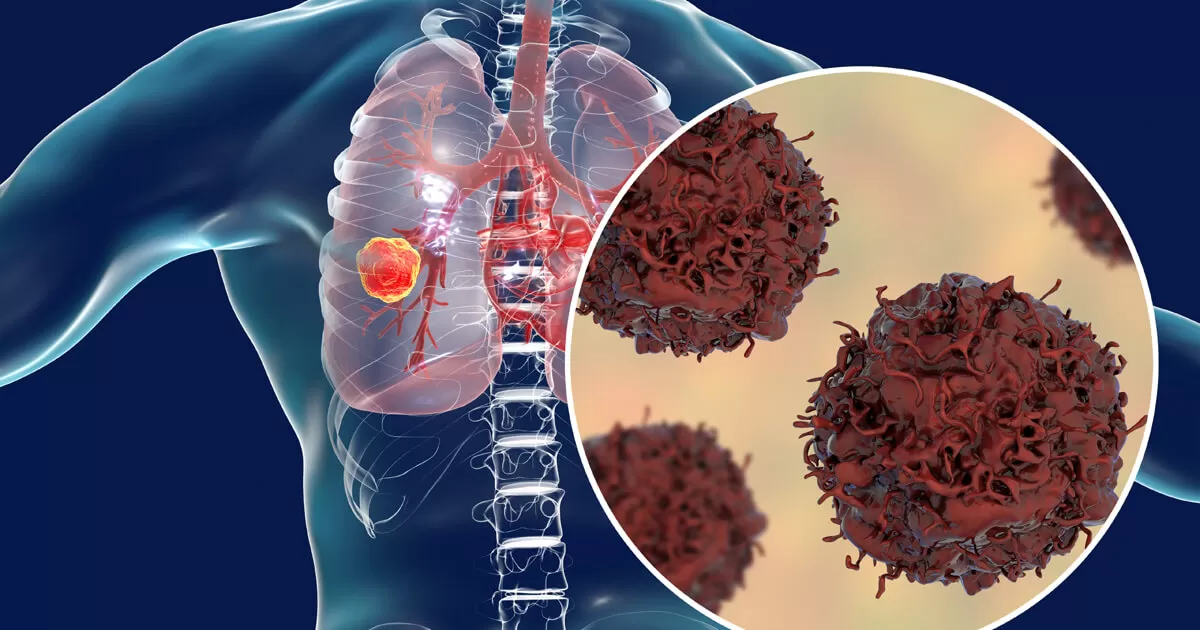 ../Image/lung-cancer4.jpeg