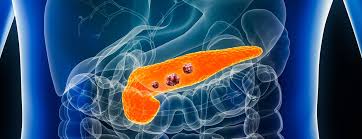 ../Image/pancreatic-cancer1.jpeg