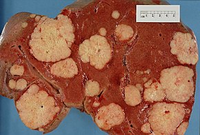../Image/pancreatic-cancer2.jpeg