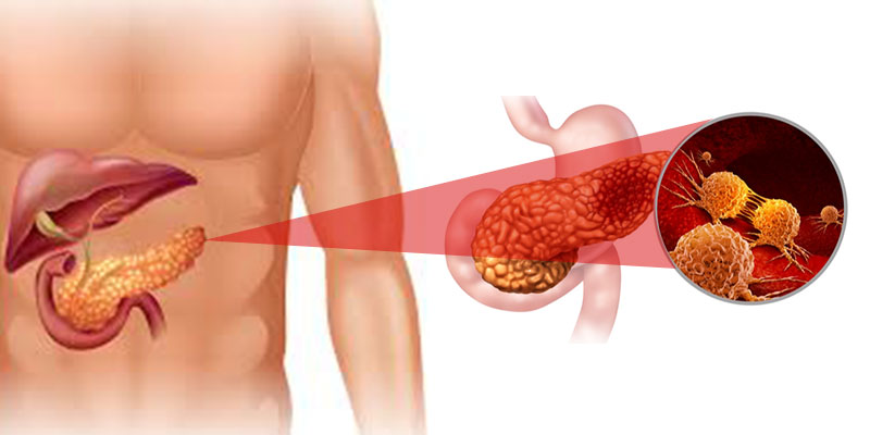 ../Image/pancreatic-cancer3.jpeg