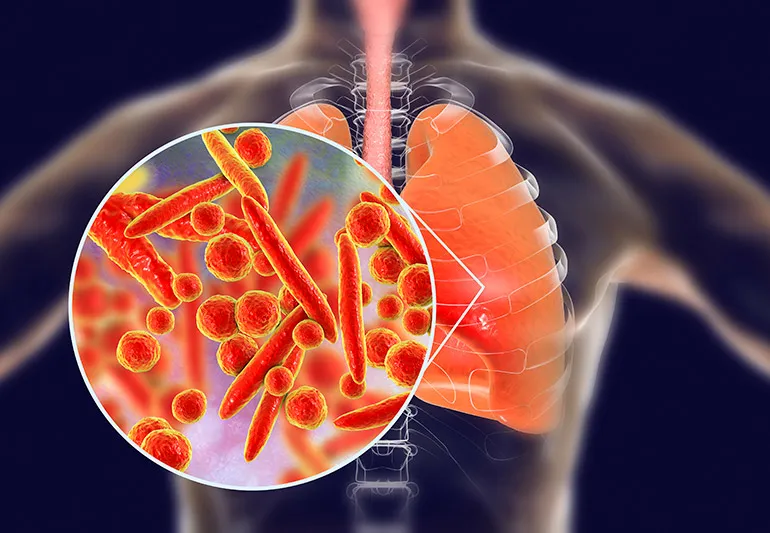 ../Image/pneumonia1
