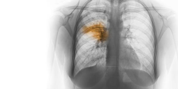 ../Image/pneumonia2.jpeg