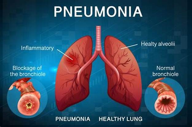 ../Image/pneumonia3.jpeg
