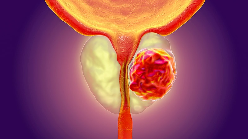 ../Image/prostate-cancer3.jpeg