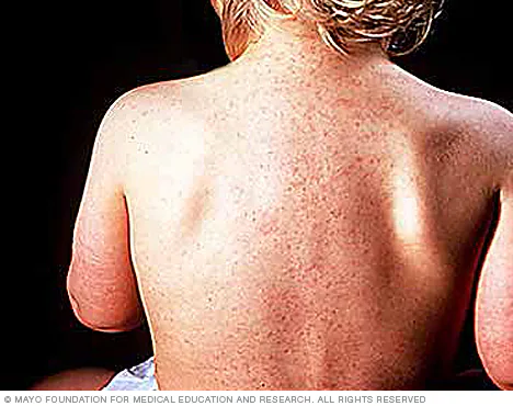 ../Image/roseola2.jpeg