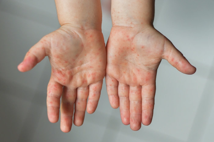 ../Image/roseola3.jpeg