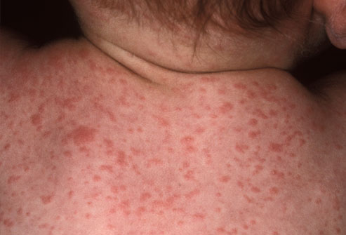 ../Image/roseola4.jpeg