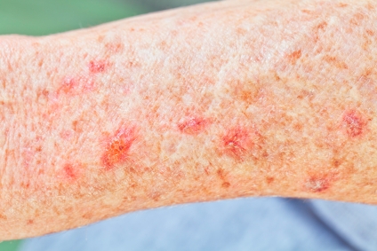 ../Image2/skin-cancer1