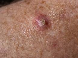 ../Image2/skin-cancer2.jpeg