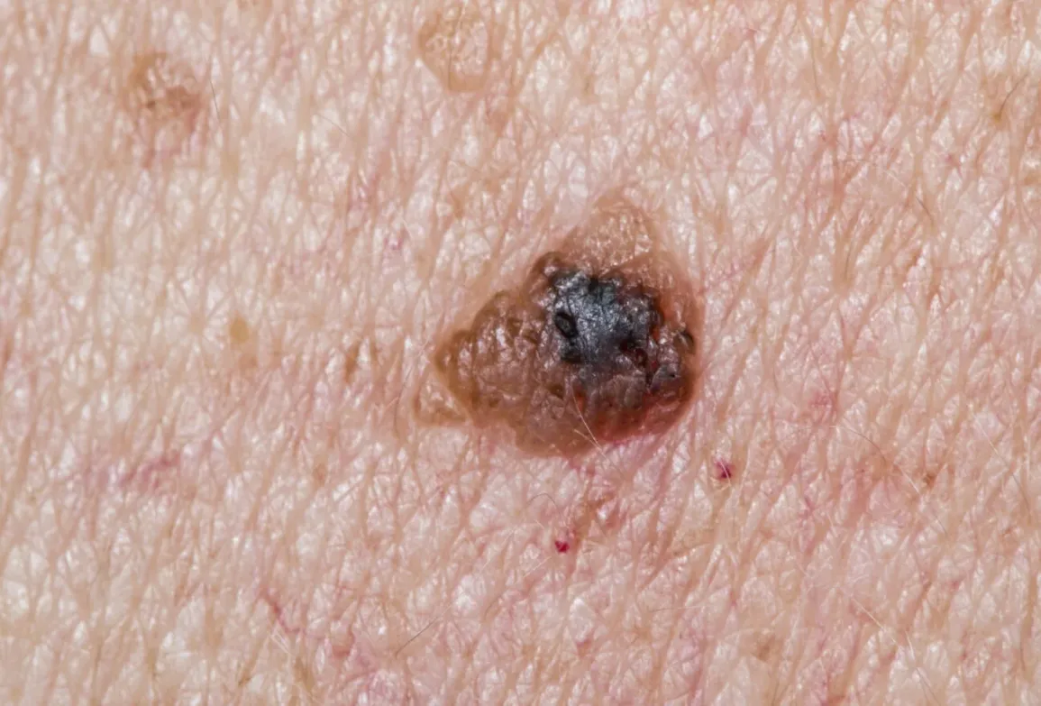 ../Image2/skin-cancer3.jpeg