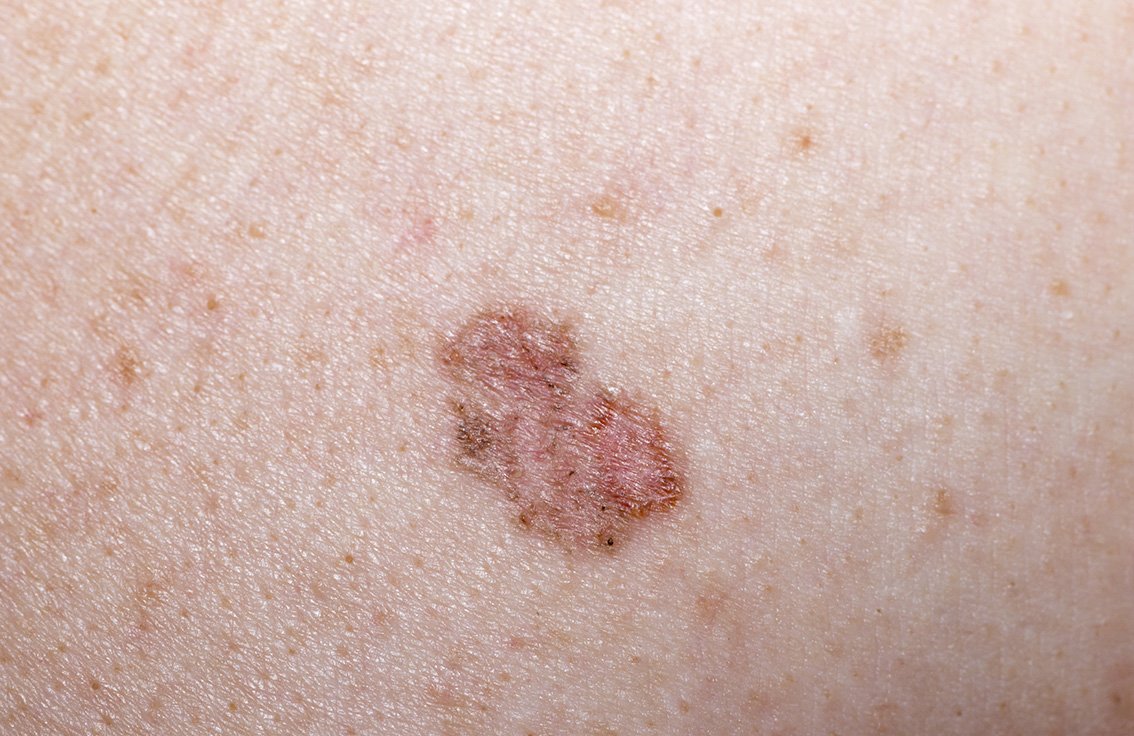 ../Image2/skin-cancer4.jpg