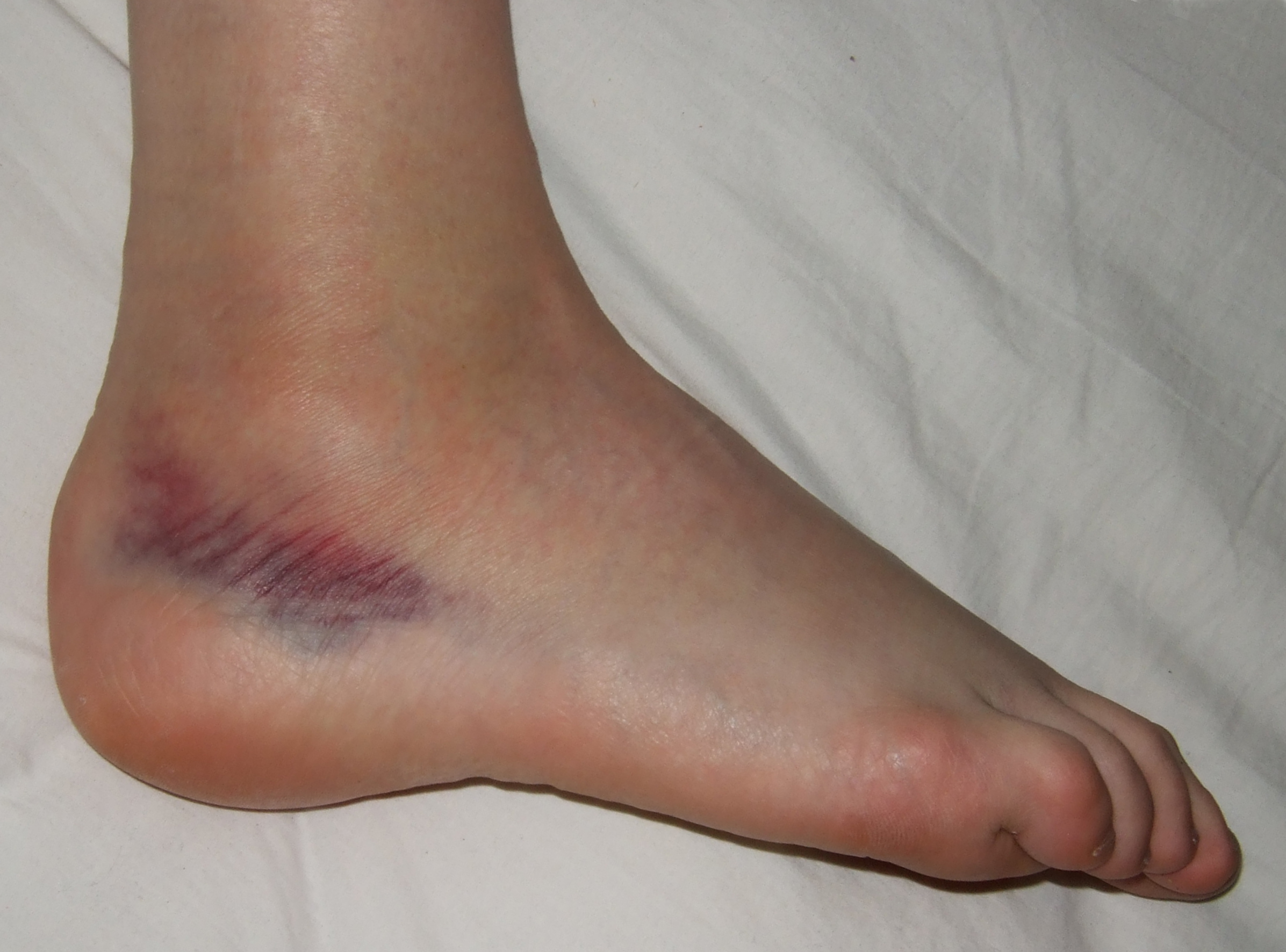 ../Image2/sprain1.jpeg