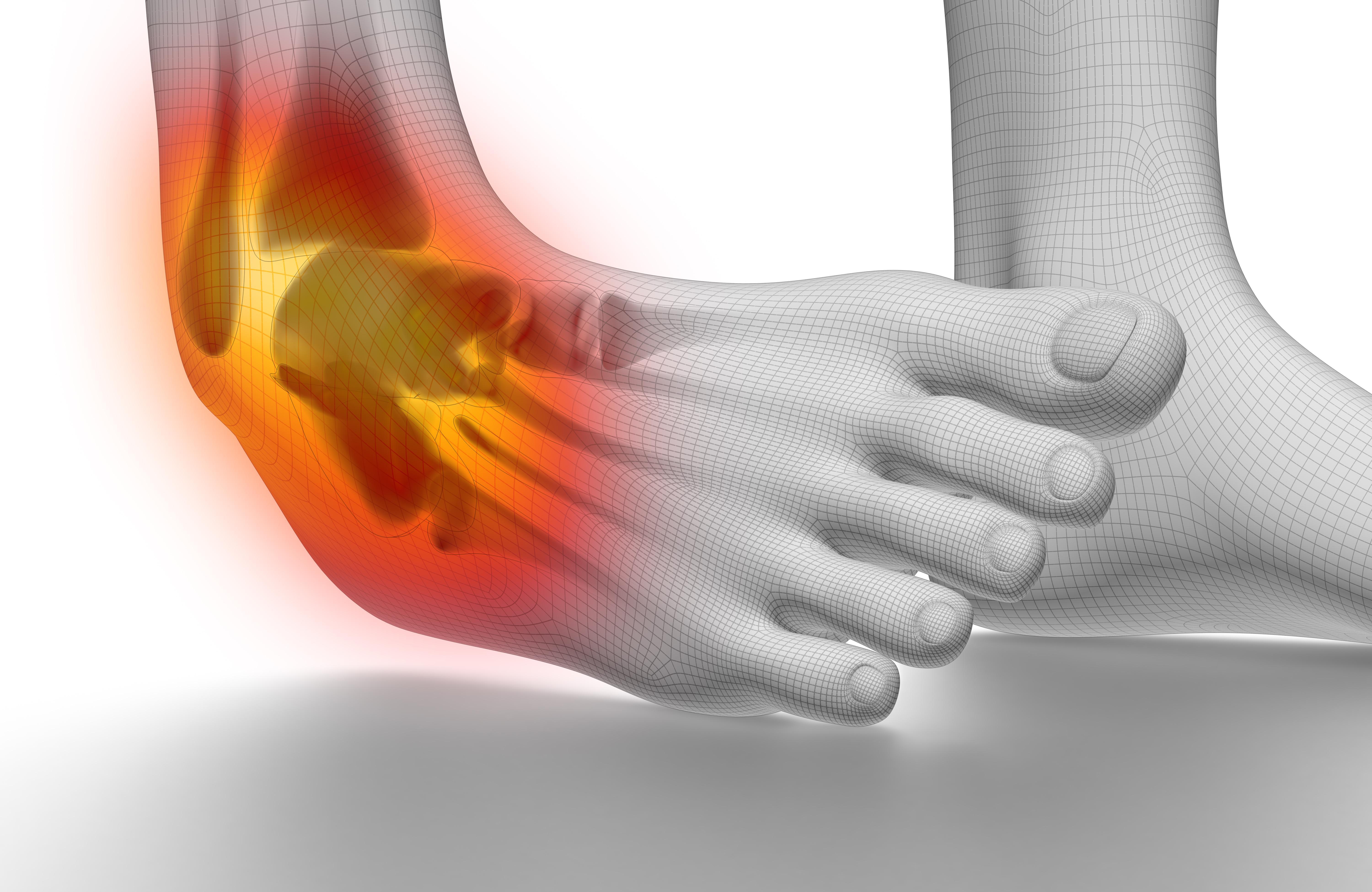 ../Image2/sprain2.jpeg
