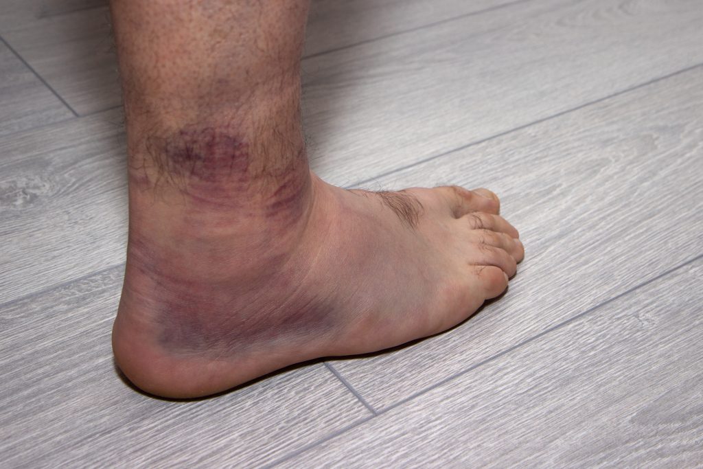 ../Image2/sprain1