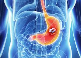 ../Image2/stomach-cancer2.jpeg