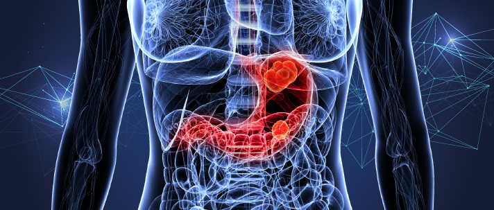 ../Image2/stomach-cancer4.jpeg