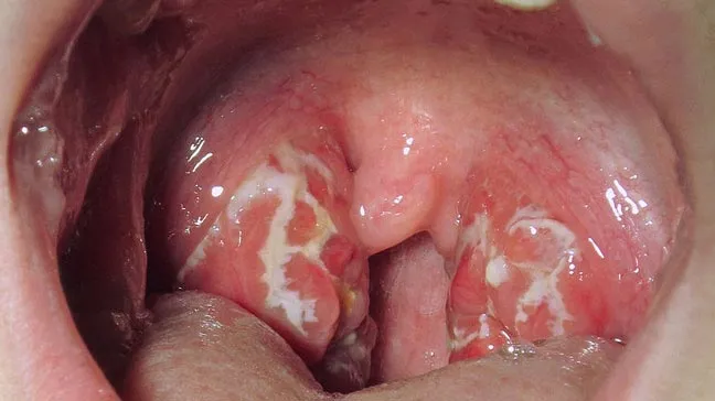 ../Image2/strep4.jpeg